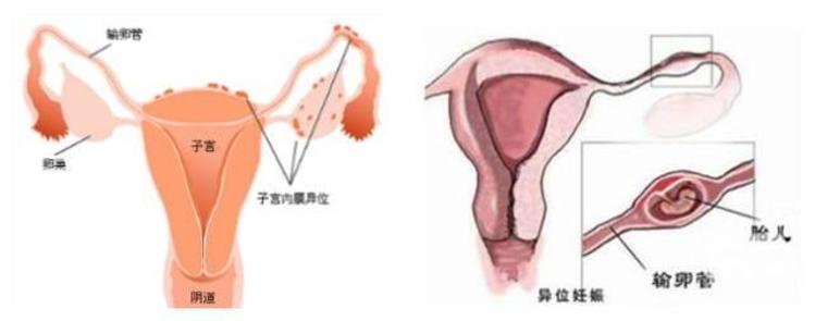 不孕症