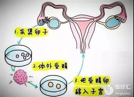 不孕治疗费用