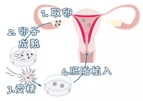 促排卵治疗