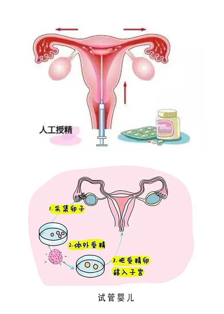 52岁闭经做试管
