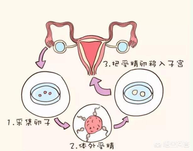 取卵手术